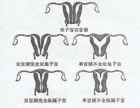 子宫畸形并不是你做试管婴儿的指证