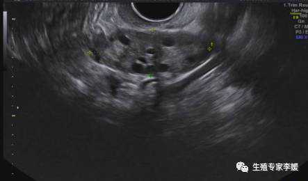 做试管婴儿期间为什么要频繁做B超 做试管婴儿期间为什么要频繁做B超